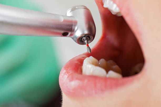 Best Emergency Tooth Extraction in Pleasant Hills, MD